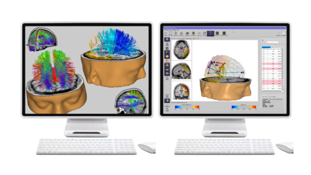 neuronavigator-hersenactiviteit-meten Hersenactiviteit meten